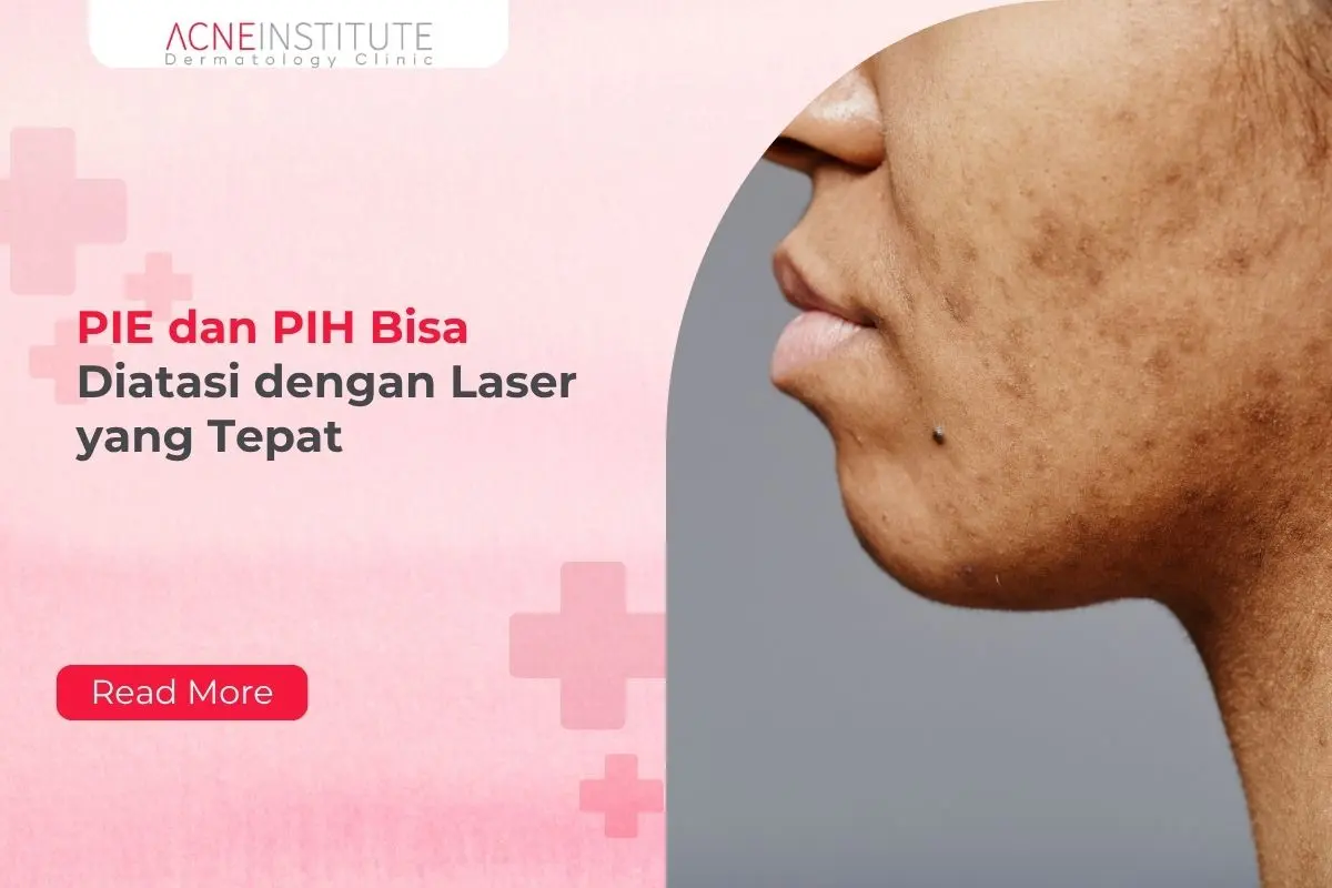 PIE dan PIH Bisa Diatasi dengan Laser yang Tepat