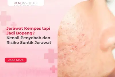 Jerawat Kempes tapi Jadi Bopeng? Kenali Penyebab dan Risiko Suntik Jerawat