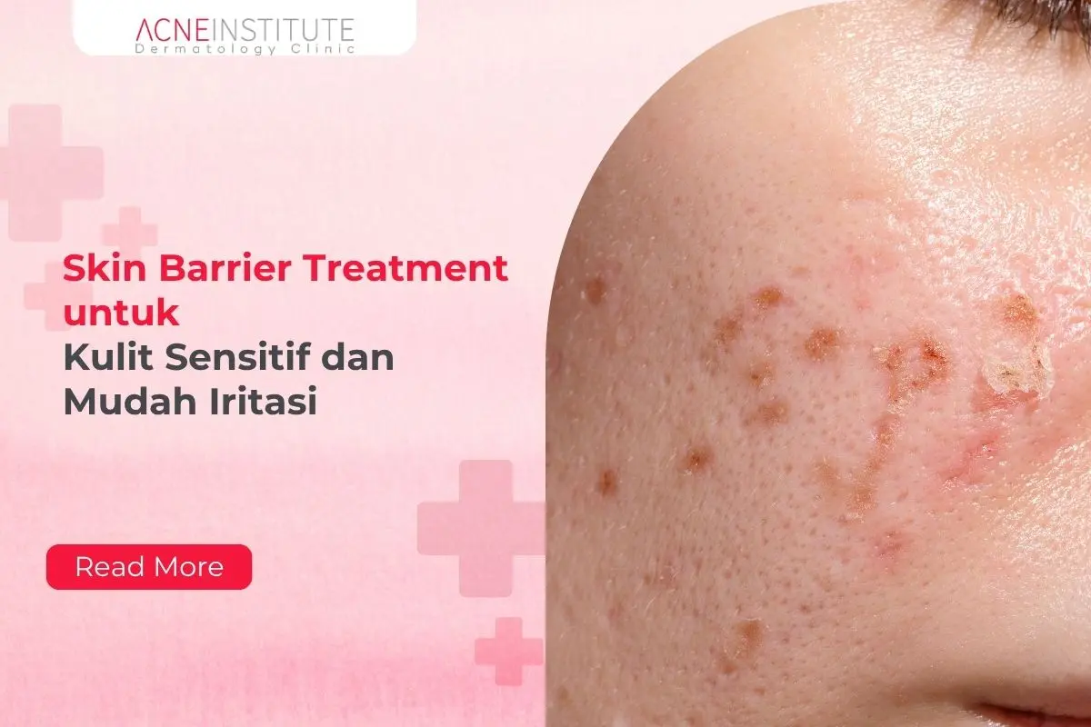 Skin Barrier Treatment untuk Kulit Sensitif dan Mudah Iritasi