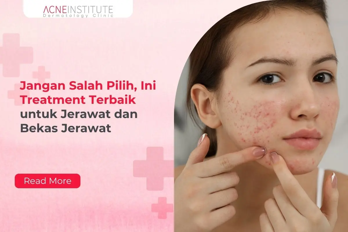 Jangan Salah Pilih, Ini Treatment Terbaik untuk Jerawat dan Bekas Jerawat