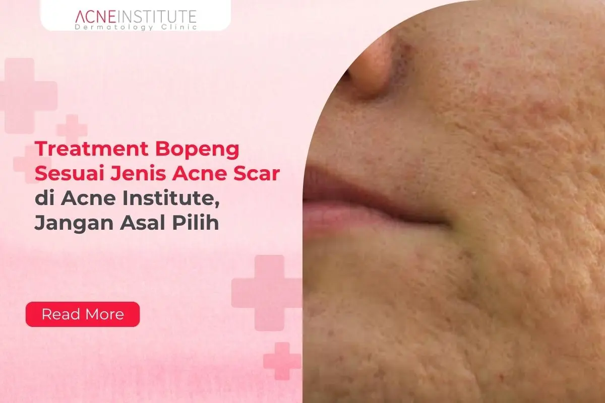 Treatment Bopeng Sesuai Jenis Acne Scar di Acne Institute, Jangan Asal Pilih
