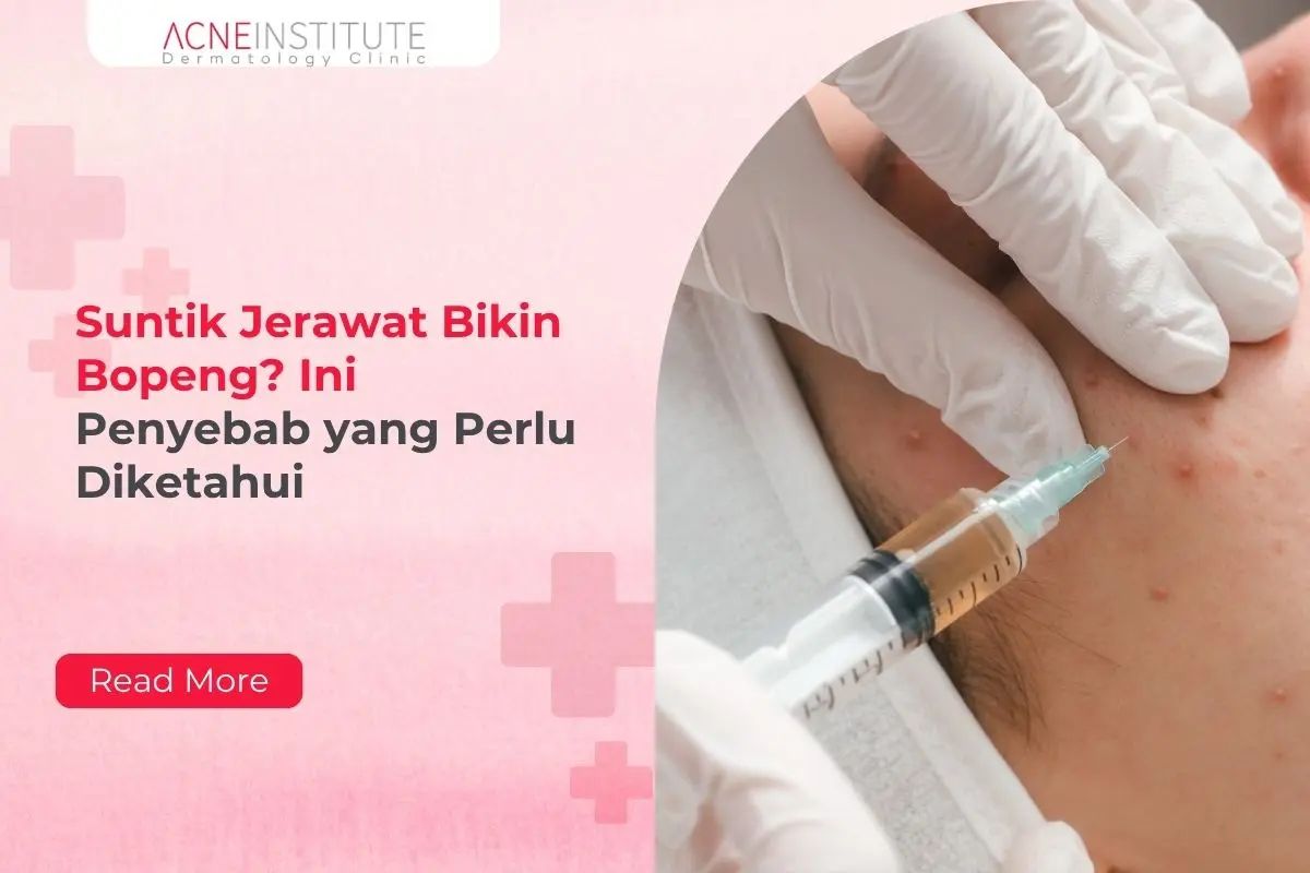 Suntik Jerawat Bikin Bopeng? Ini Penyebab yang Perlu Diketahui