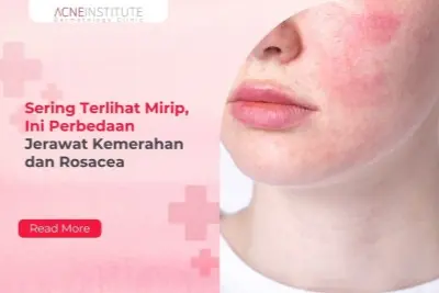 Sering Terlihat Mirip, Ini Perbedaan Jerawat Kemerahan dan Rosacea