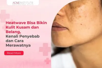 Heatwave Bisa Bikin Kulit Kusam dan Belang, Kenali Penyebab dan Cara Merawatnya