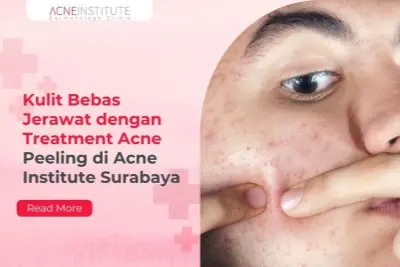 Kulit Bebas Jerawat dengan Treatment Acne Peeling di Acne Institute Surabaya