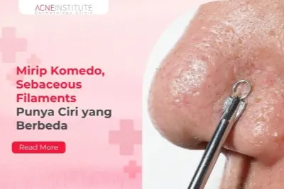 Mirip Komedo, Sebaceous Filaments Punya Ciri yang Berbeda
