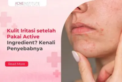 Kulit Iritasi setelah Pakai Active Ingredient? Kenali Penyebabnya