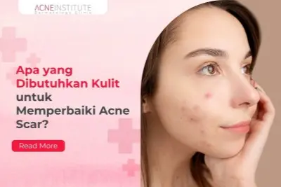 Apa yang Dibutuhkan Kulit untuk Memperbaiki Acne Scar?