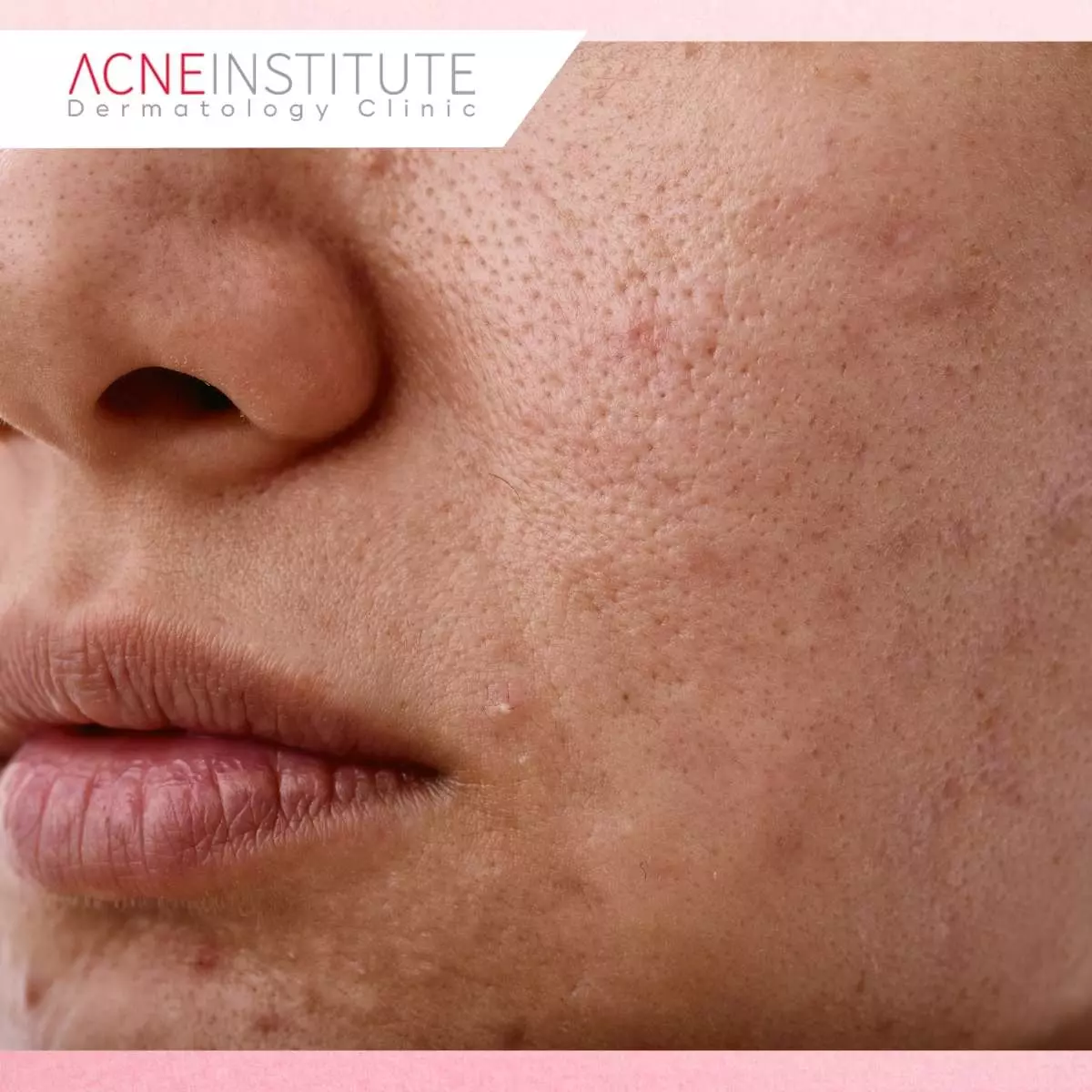 Seberapa Penting Skin Barrier