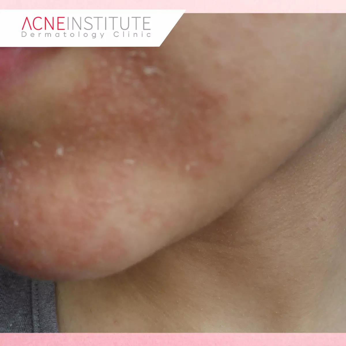 Gejala Seborrheic Dermatitis yang Perlu Diwaspadai