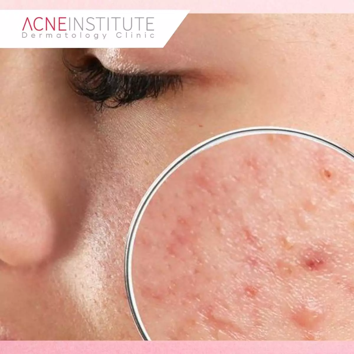 Mengapa Rosacea Sering Dikira Jerawat Biasa?