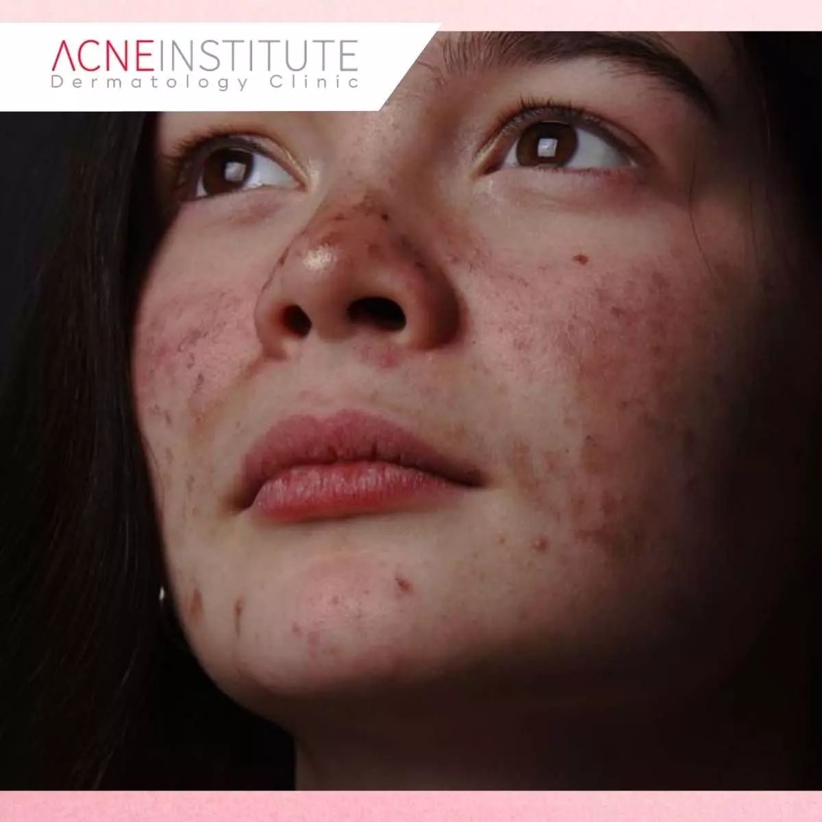 Tanda Kulit Kamu Mungkin Mengalami Rosacea, Bukan Jerawat