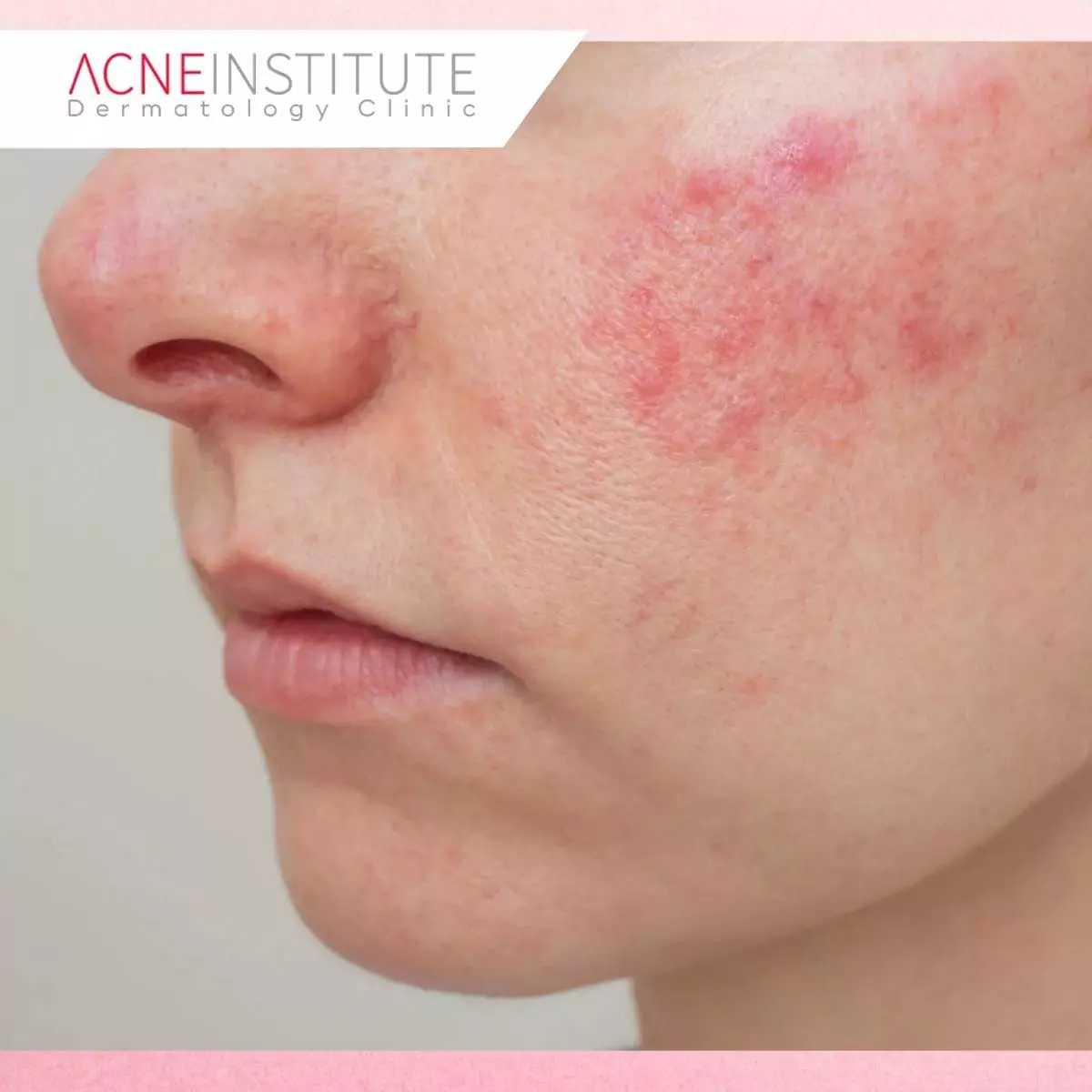 Cara Penanganan Rosacea dan Jerawat dengan Aman dan Tepat