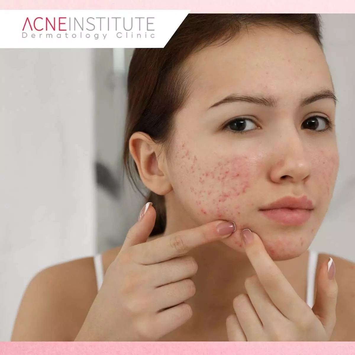Bagaimana Cara Membedakan Pori-Pori Besar dengan Acne Scar?