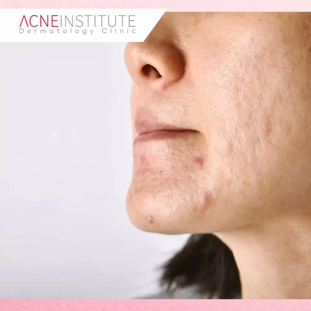 Apa Itu Rolling Scar dan Mengapa Tekstur Kulit Terlihat Bergelombang?