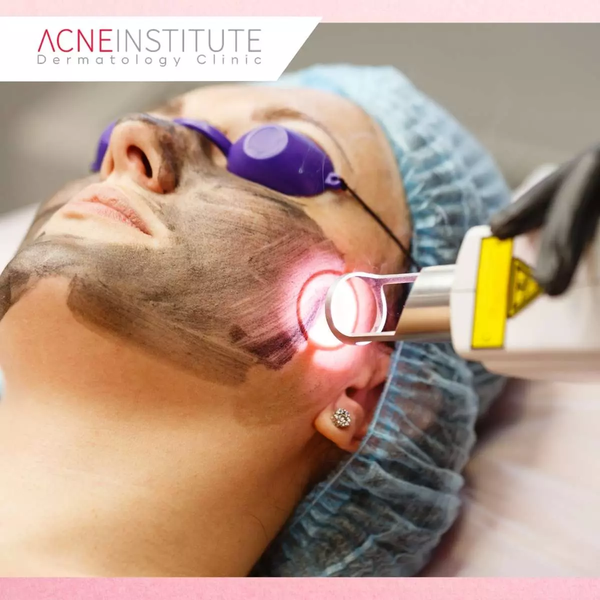Bagaimana Cara Kerja Laser Frax?