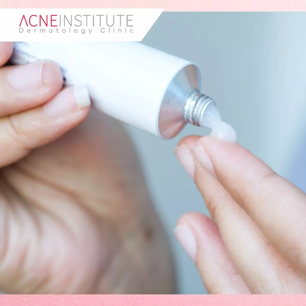 Apa Itu Steroid-Induced Acne?