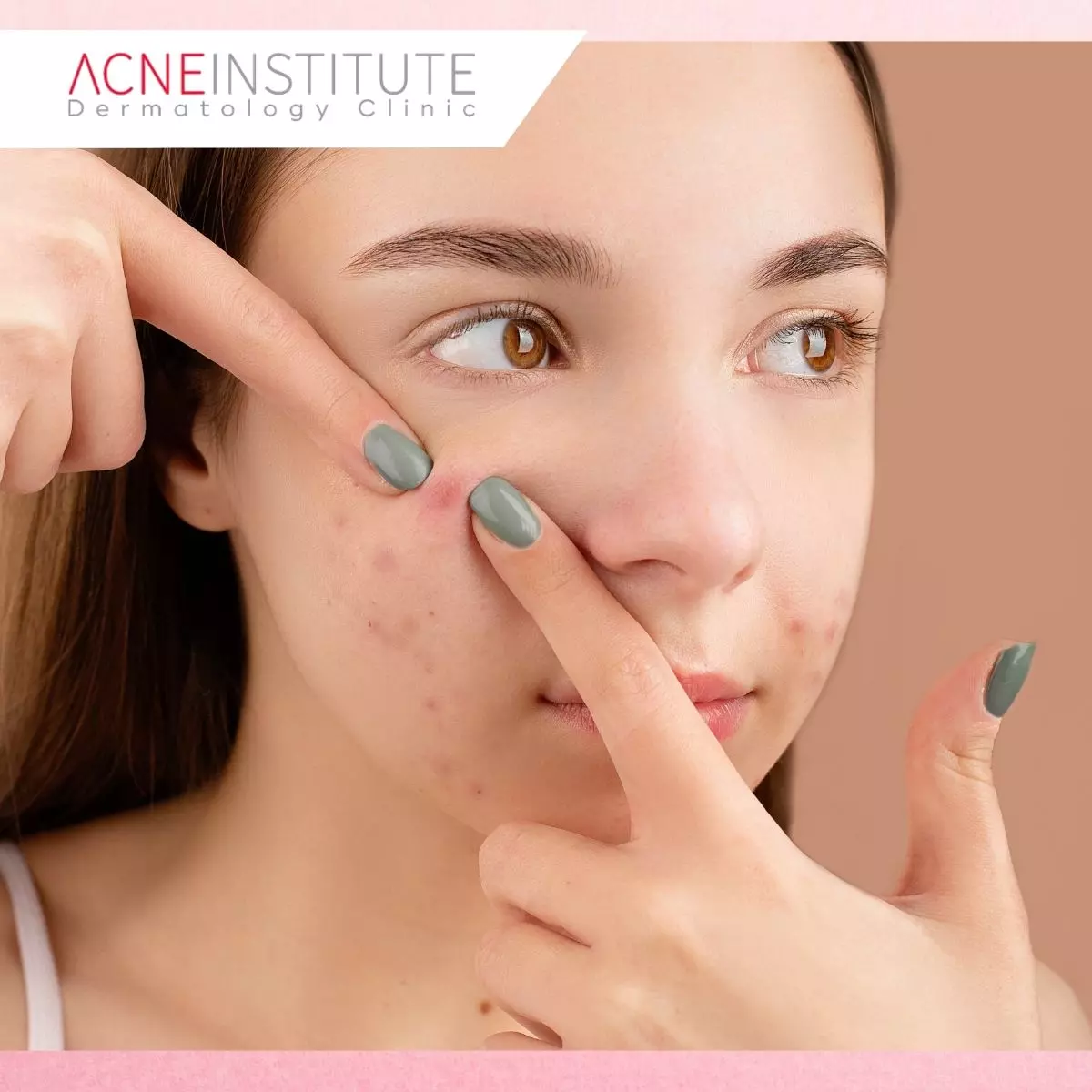 Mengenal Downtime dan Proses Pemulihan Kulit Setelah Treatment Jerawat