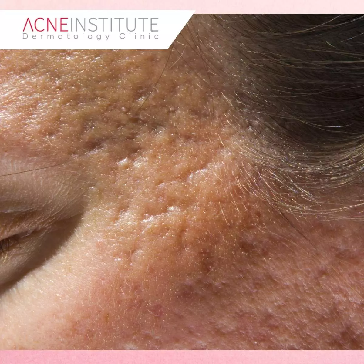Solusi Treatment Bekas Jerawat Sesuai Jenisnya di Acne Institute Surabaya