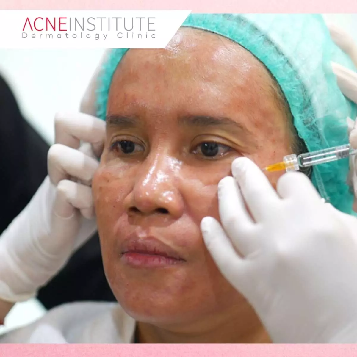 Berapa Lama Hasil Collagen Stimulator Terlihat?