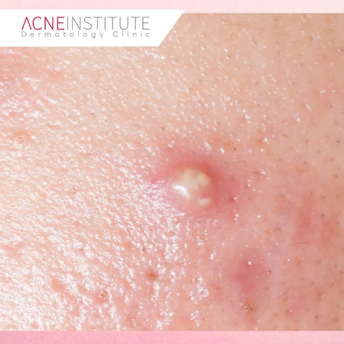 Apa Itu Over-Treating Acne?
