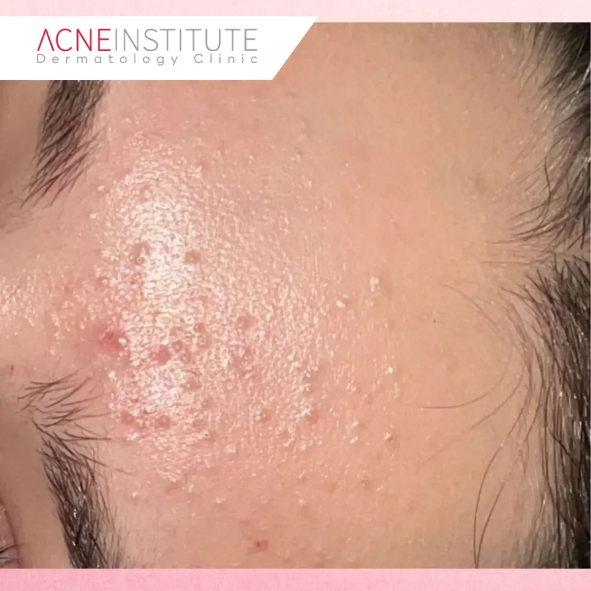 Mengapa Treatment Jerawat Perlu Disesuaikan dengan Kondisi Kulit?
