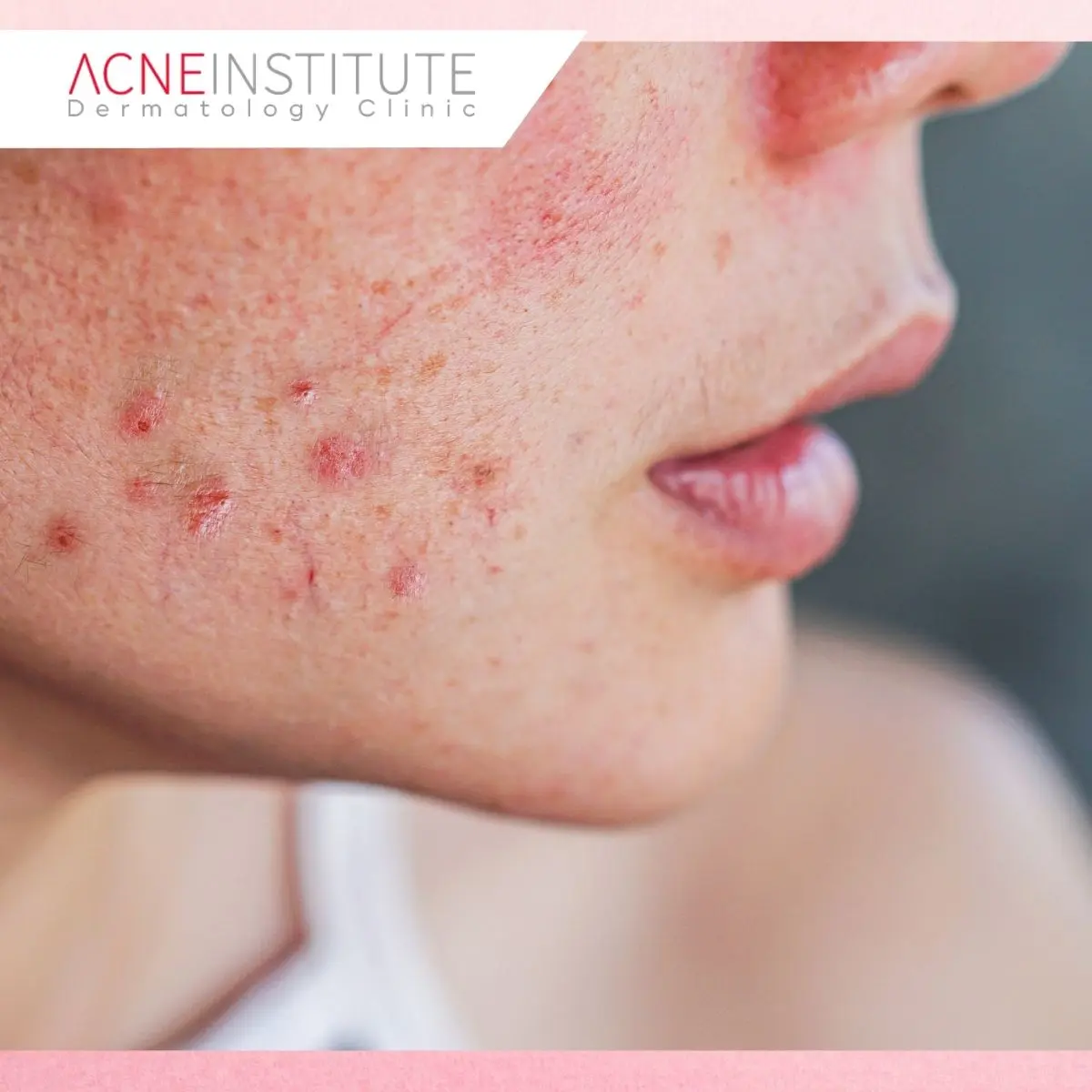Kenali Kondisi Jerawat Sebelum Menentukan Treatment