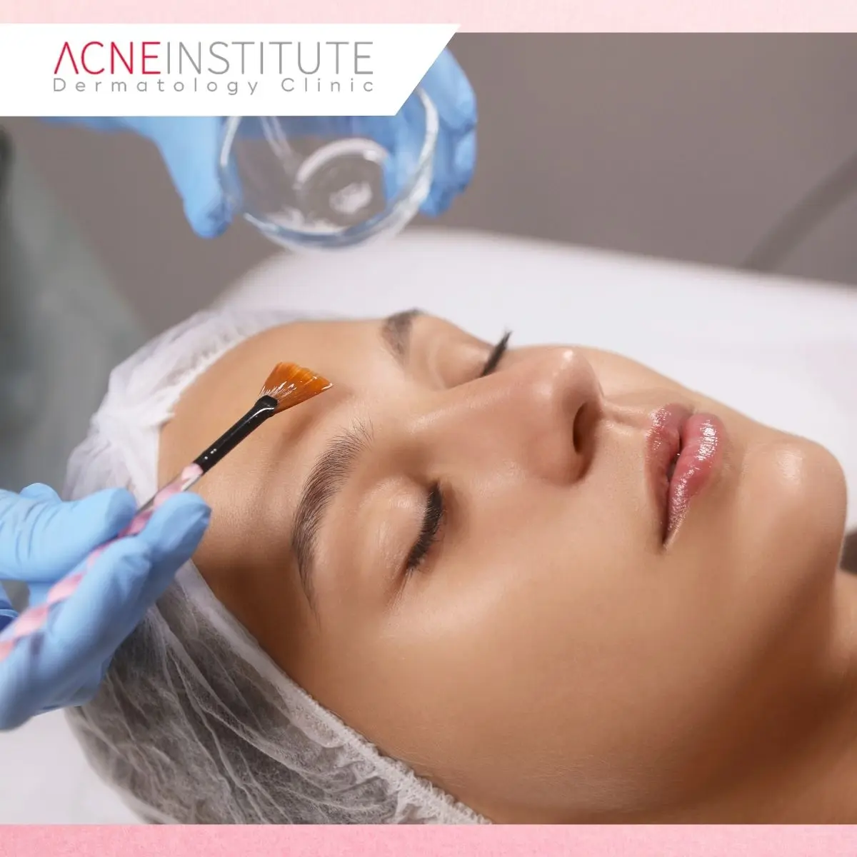 Mengapa Memilih Treatment Jerawat di Acne Institute jakarta?