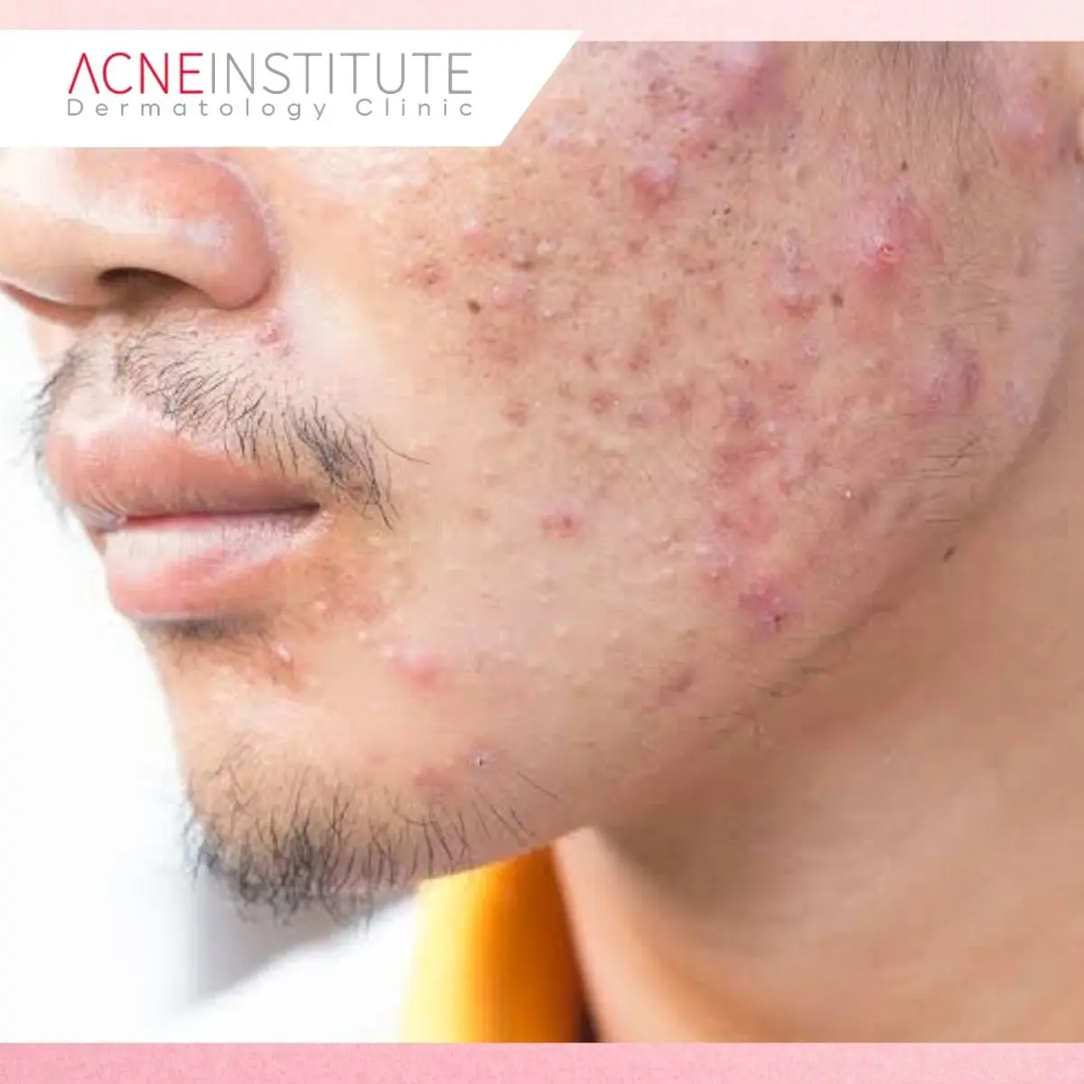 Mengenal Macular Scars pada Bekas Jerawat