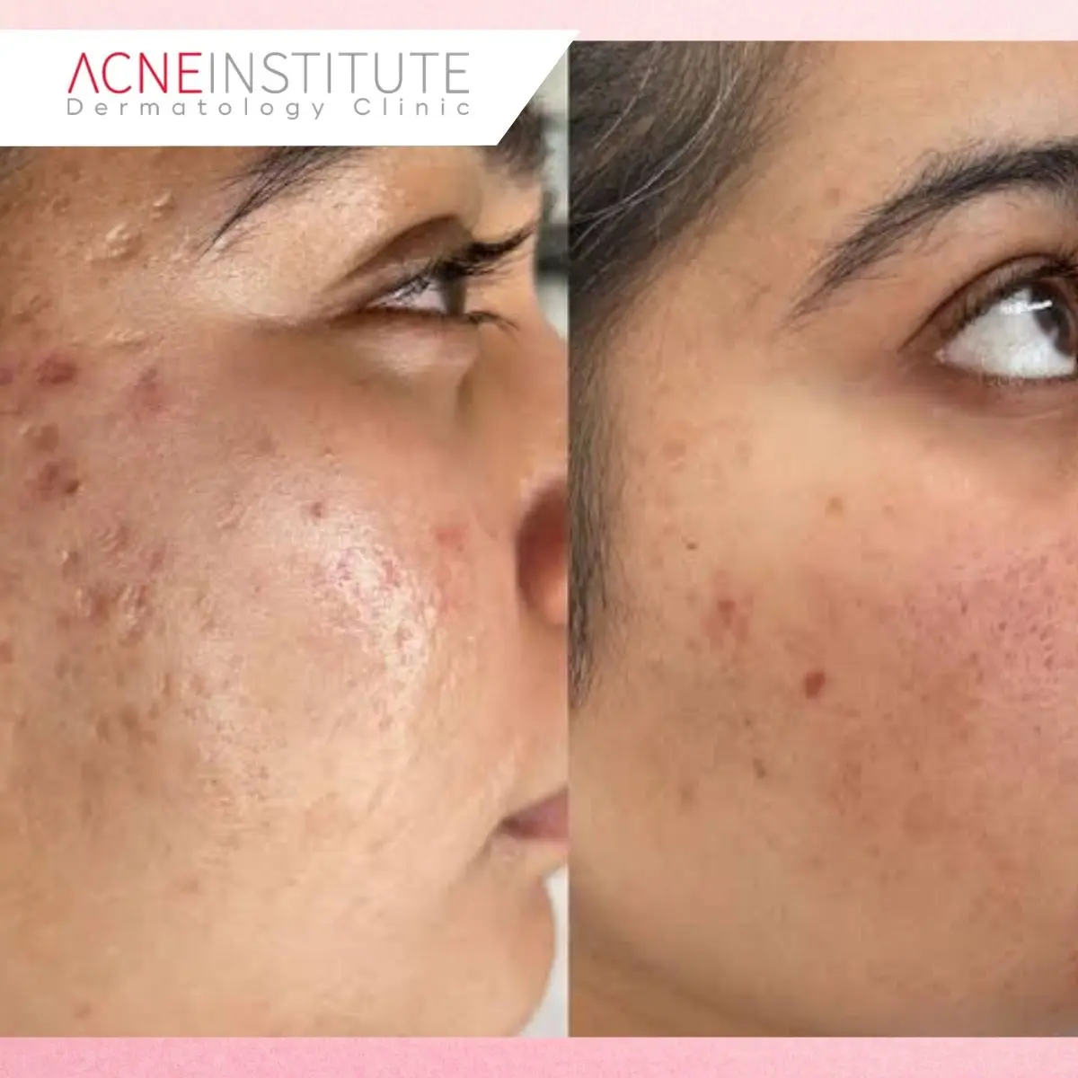 Berapa Lama Macular Scars Bisa Bertahan?