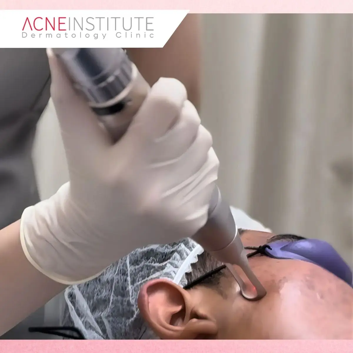 Mengapa Treatment Jerawat dan Bekasnya Tidak Bisa Disamakan?