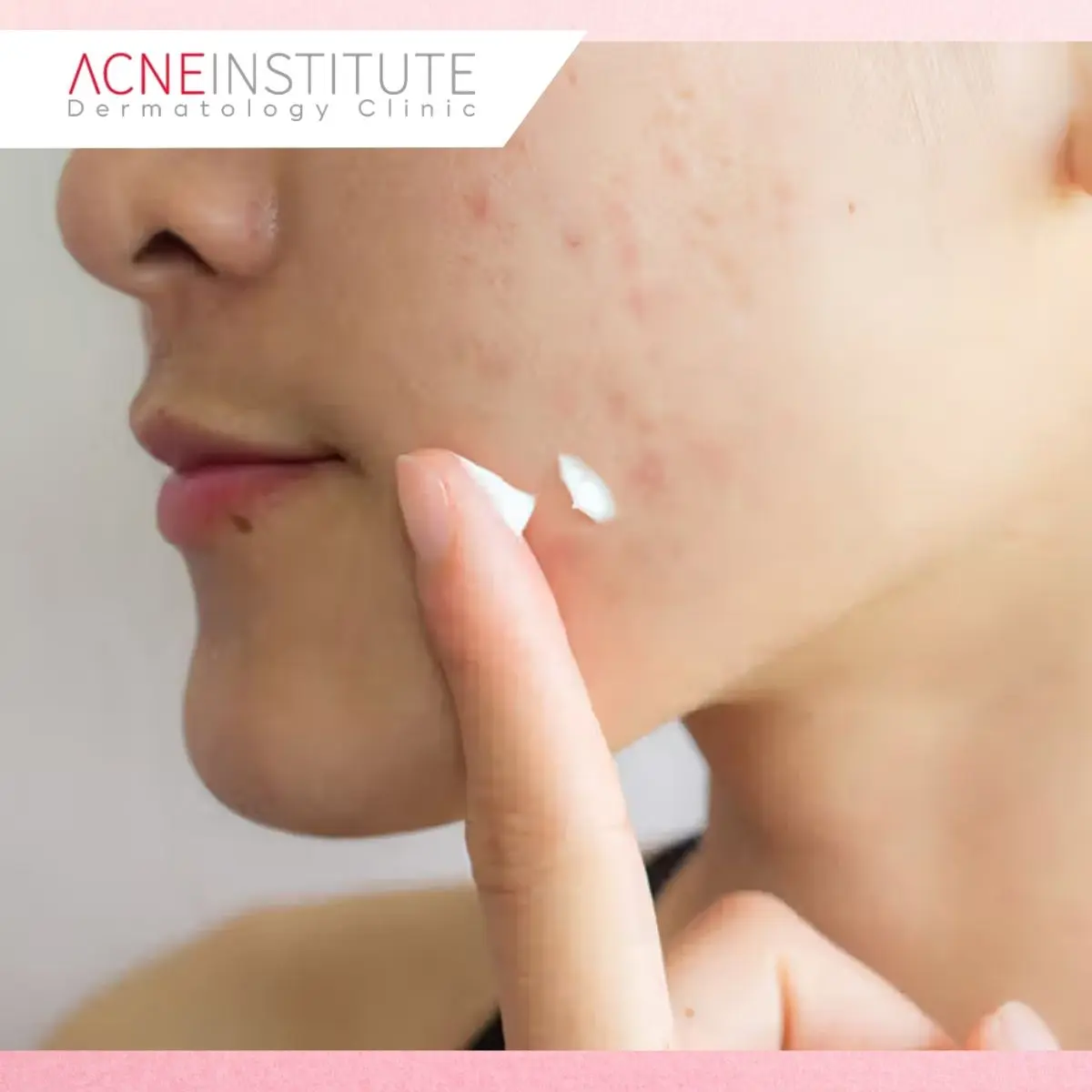 Tips Memilih Treatment Jerawat dan Bekasnya yang Tepat