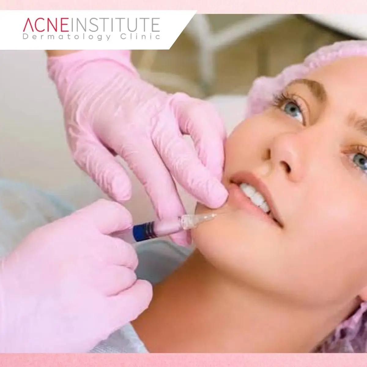1. Semua Bopeng Bisa Hilang Hanya dengan Skincare