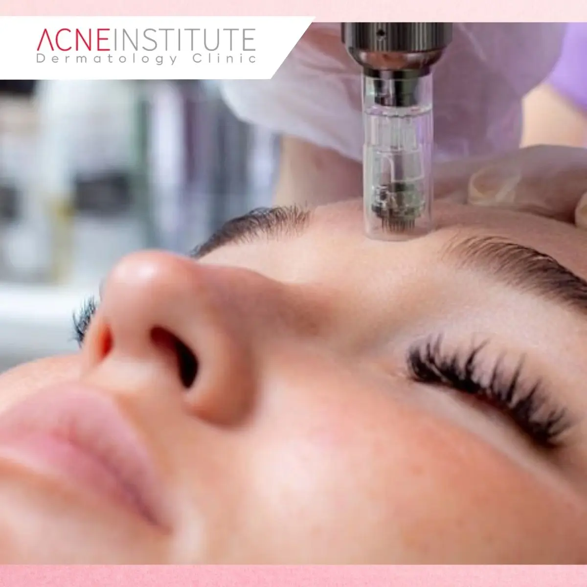 3. Semakin Agresif Treatment, Semakin Cepat Bopeng Hilang