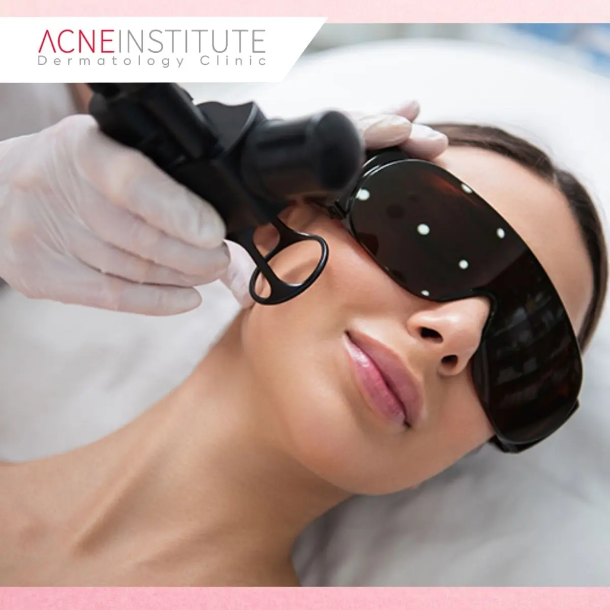 5. Satu Kali Treatment Sudah Cukup untuk Menghilangkan Bopeng