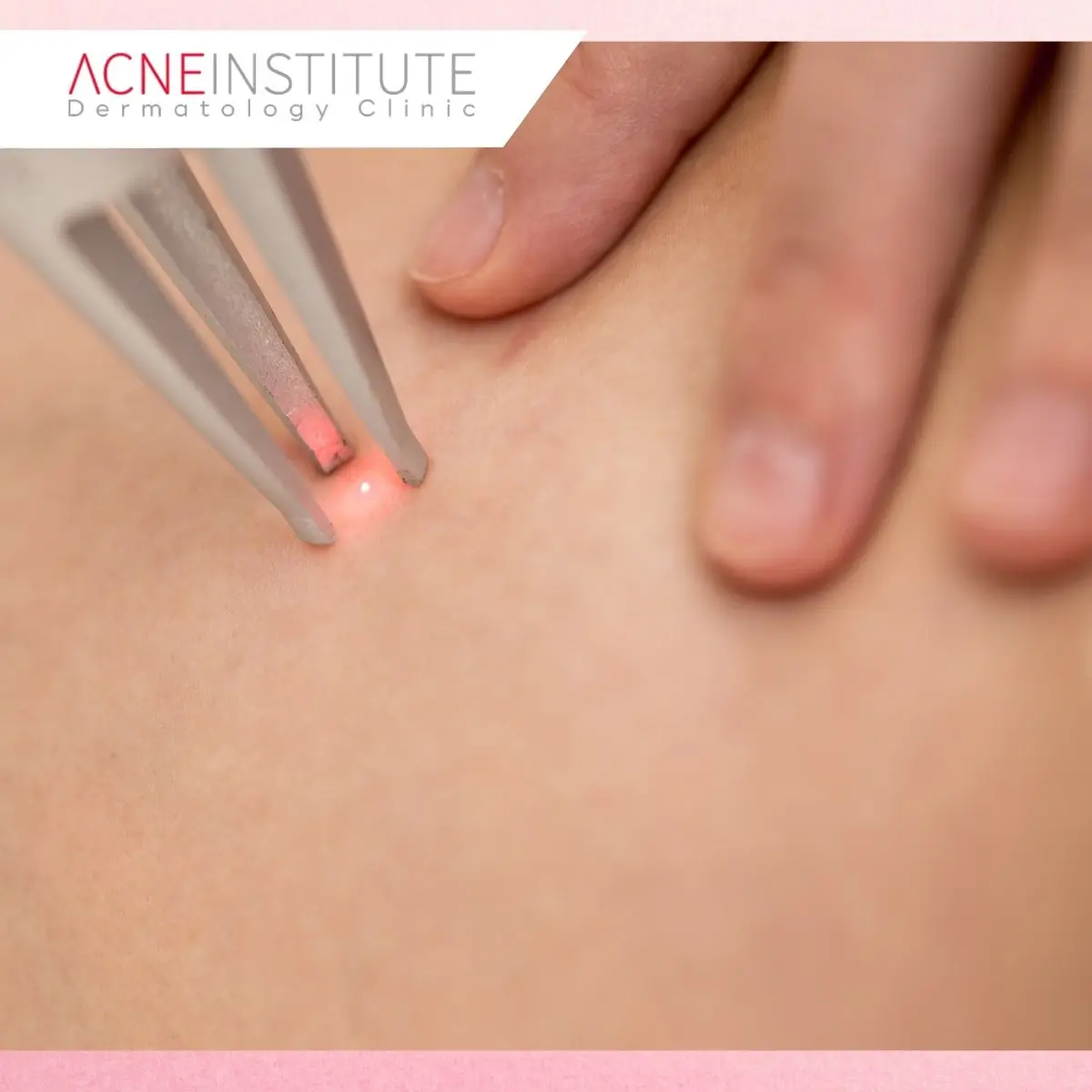 1. Konsultasi Dokter untuk Menentukan Treatment Jerawat yang Tepat