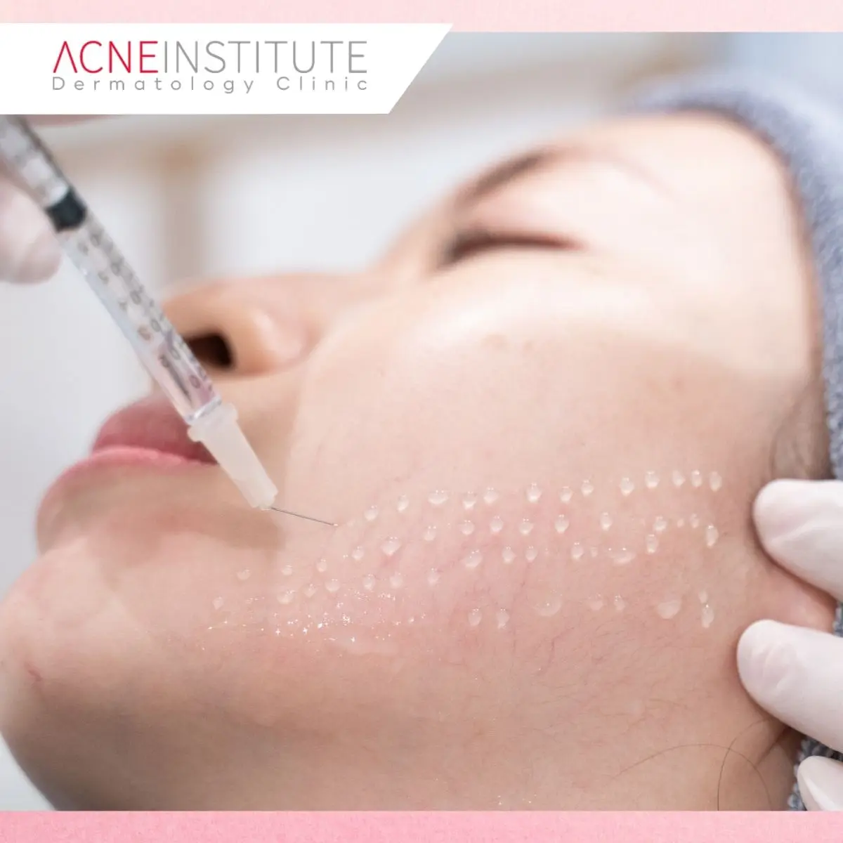 Berapa Kali Treatment Bopeng Dibutuhkan?
