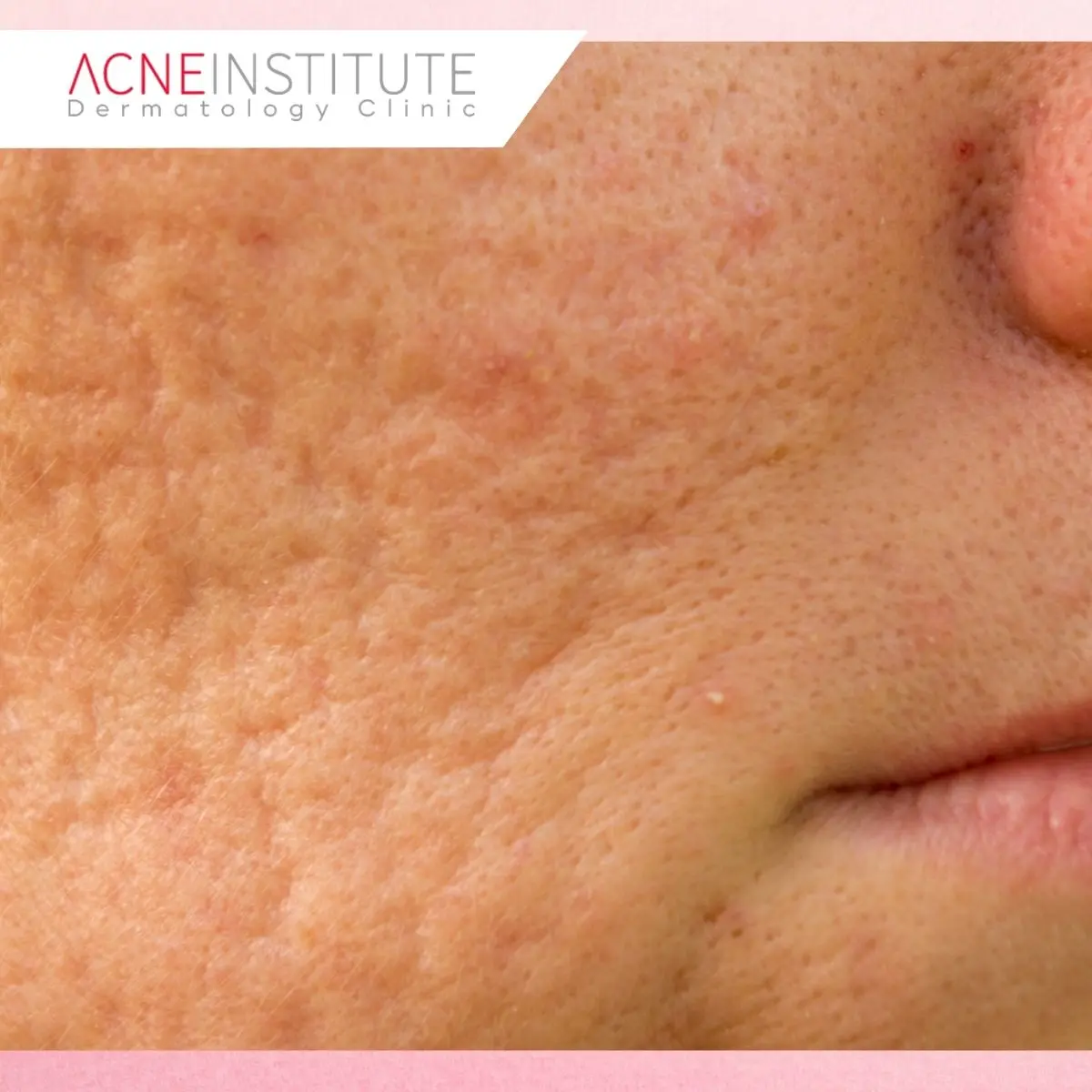 Treatment Bopeng di Acne Institute Jakarta Disesuaikan dengan Jenis Bopeng