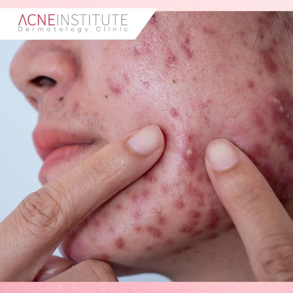 Kenali Jenis Jerawat Sebelum Memilih Treatment