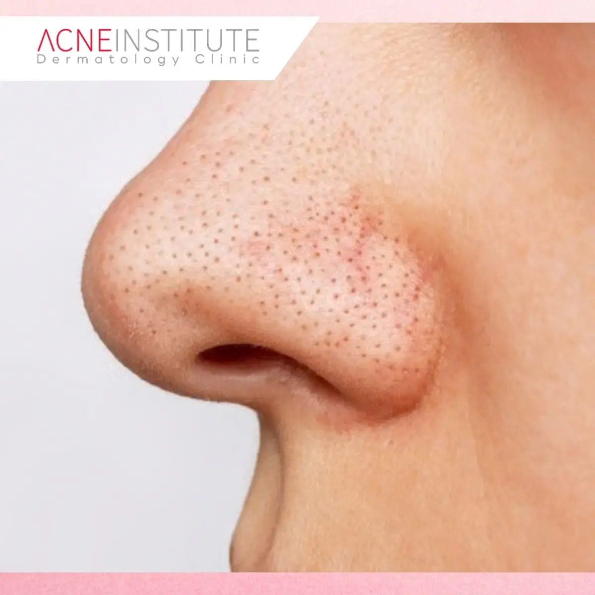 Sering Terlihat Mirip, Ini Perbedaan Jerawat Kemerahan dan Rosacea