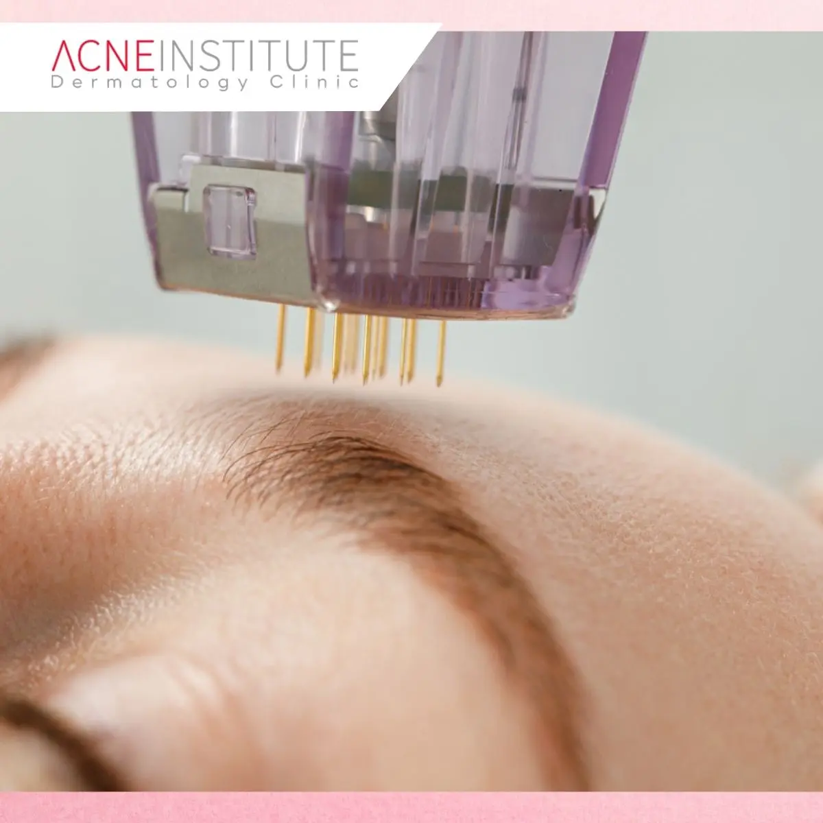 Apa Perbedaan Ketiga Treatment Anti Aging Tersebut?