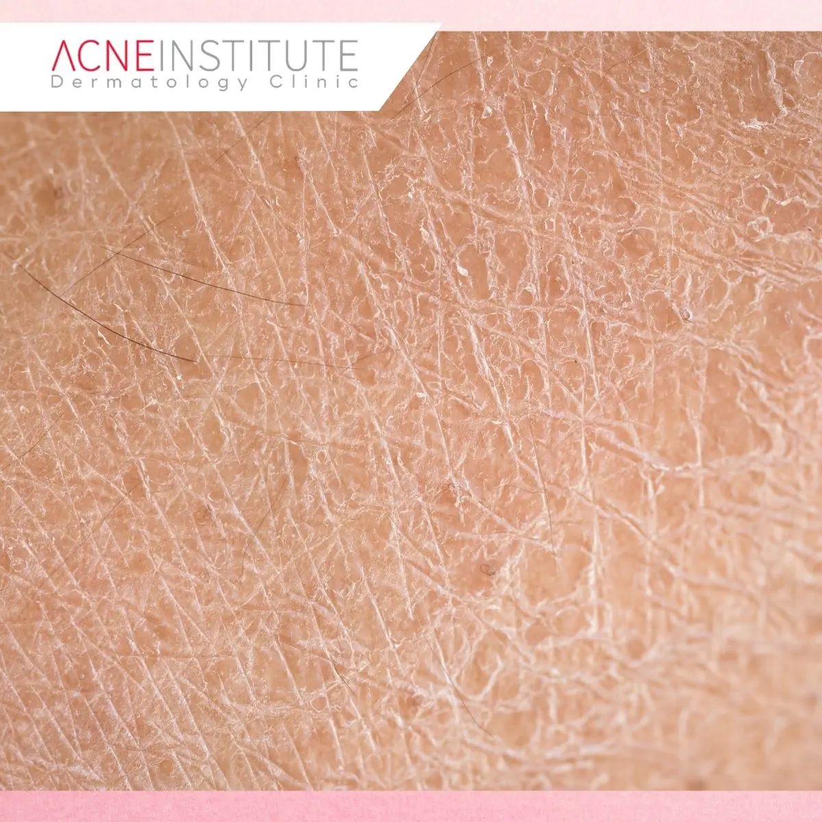 Berapa Lama Skin Barrier Bisa Pulih?
