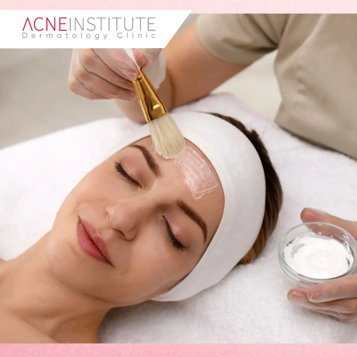 Bagaimana Acne Peeling Membantu Kulit Bebas Jerawat?