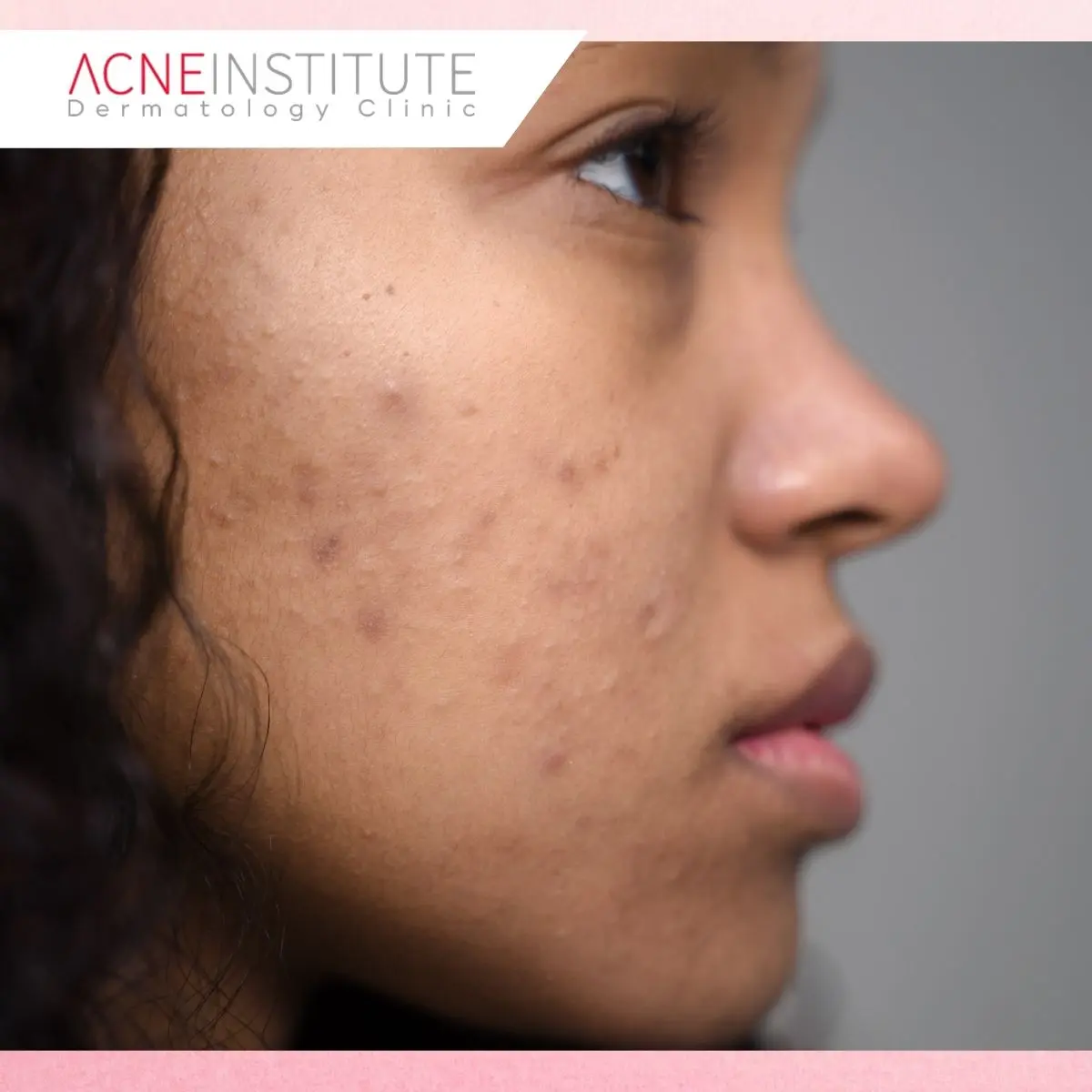 Apakah Acne Peeling Menyebabkan Kulit Mengelupas?