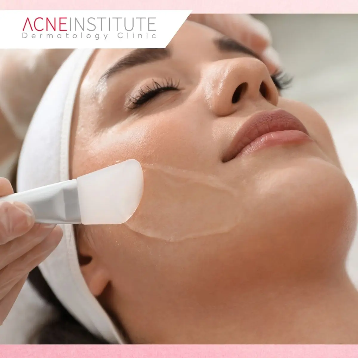 Berapa Kali Acne Peeling Perlu Dilakukan?
